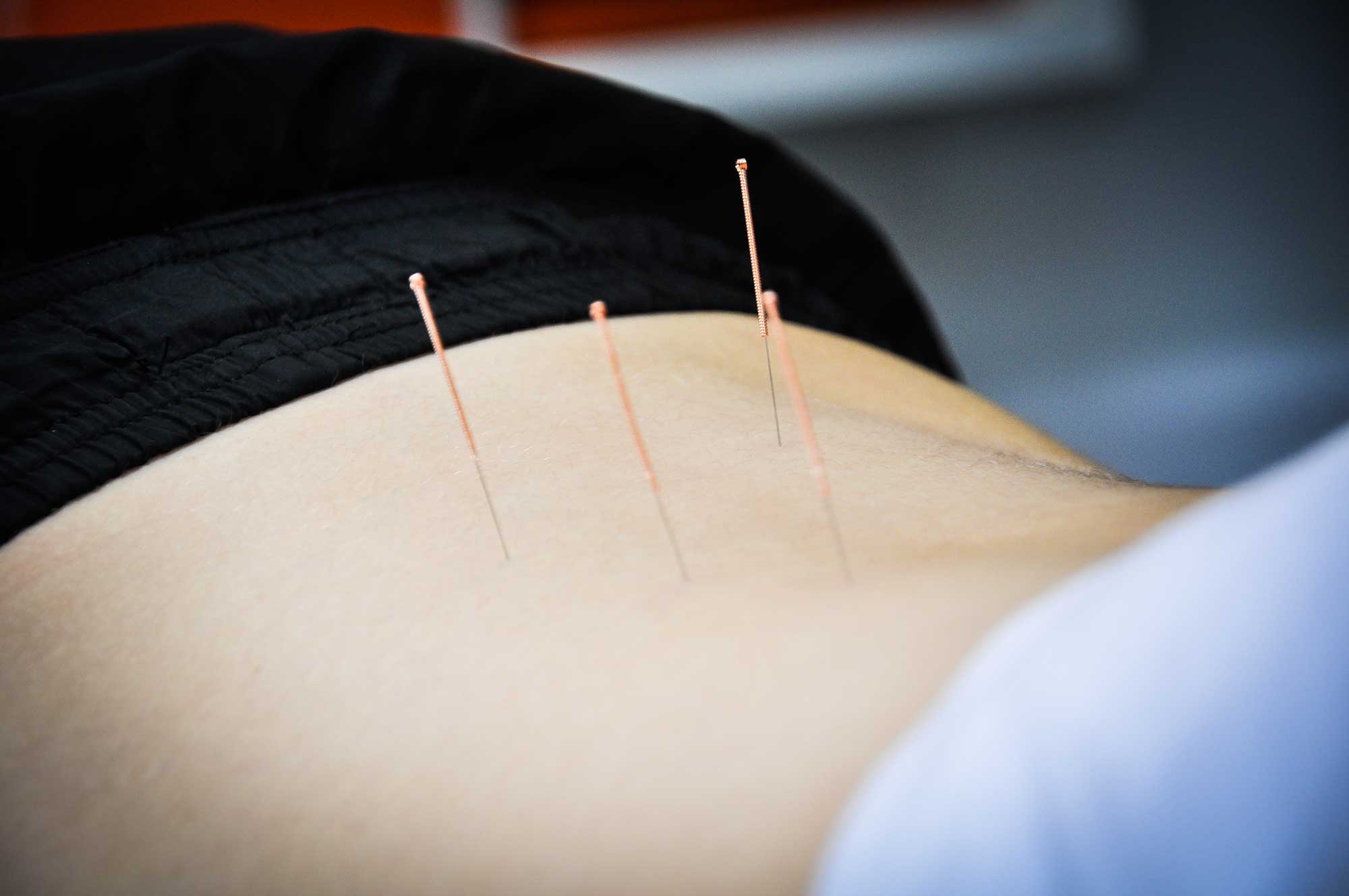 Square One - Acupuncture: Image showing acupuncture needles in the back back of patient